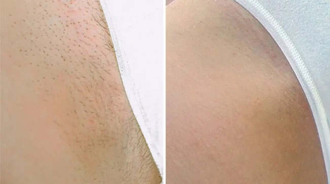 laser hair removal effect after 2nd procedure