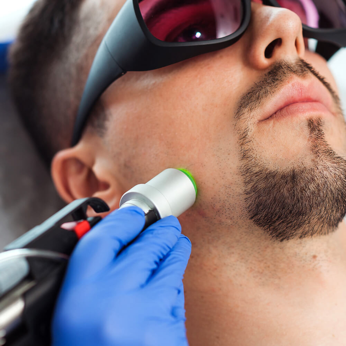 чоловіча лазерна епіляція обличчя