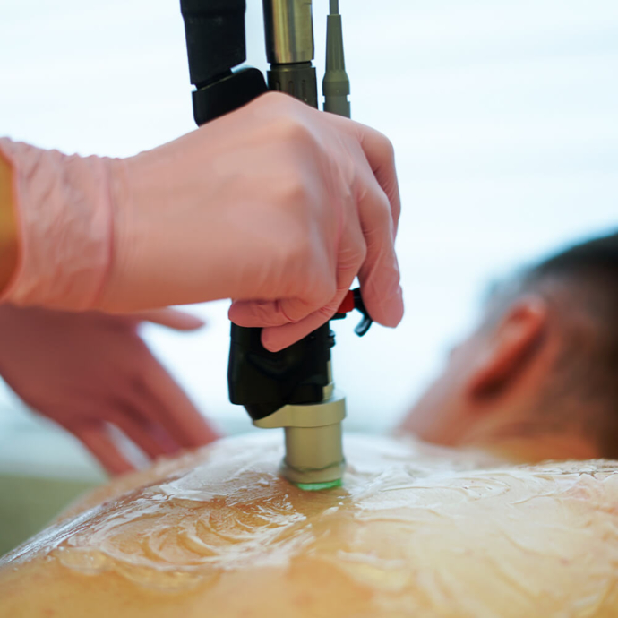 лазерна епіляція спина