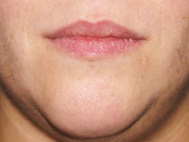 епіляція для обличчя