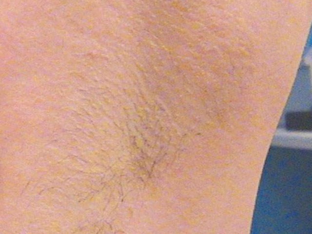 лазерная эпиляция подмышек сколько стоит