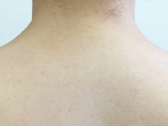 лазерна епіляція спина