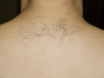 лазерна епіляція на спині