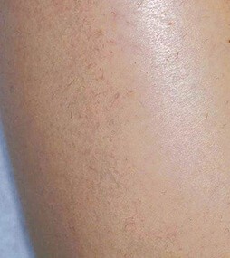 лазерна епіляція ноги повністю