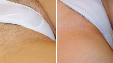 depilacja bikini przed i po