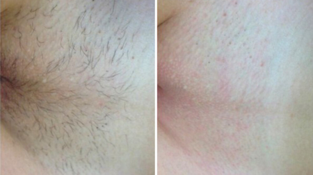 głębokie bikini konsekwencje depilacji laserowej zdjęcie