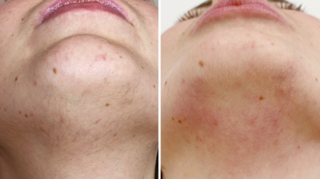 фото сразу после лазерной эпиляции