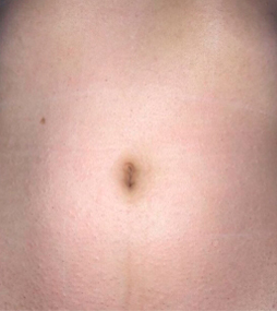 лазерна епіляція живота до і після