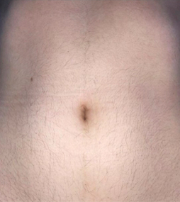 лазерна епіляція живота повністю