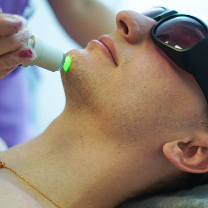 чоловіча епіляція на обличчі