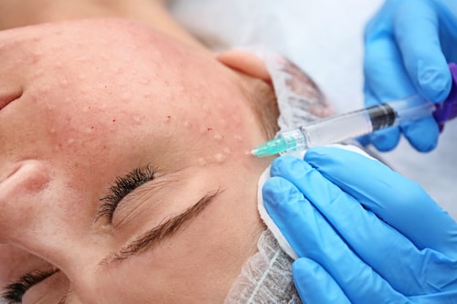 biorewitalizacja jak się odbywa