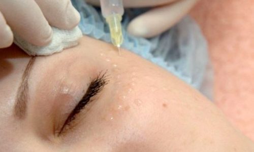 biorewitalizacja jak często powtarzać