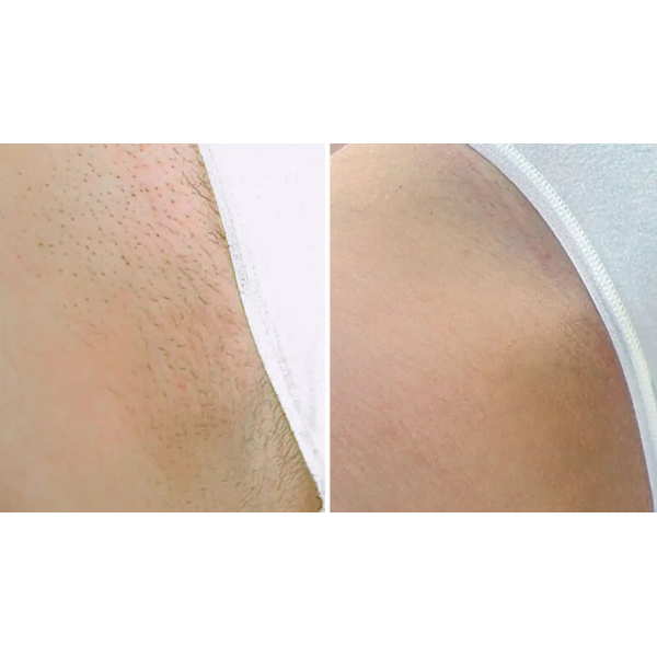 Can laser hair removal be done during menstruation?