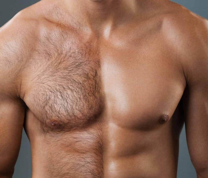 Before and after men's laser bikini treatment