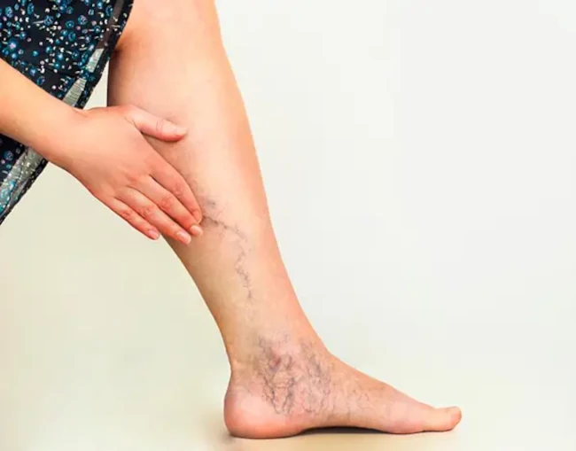 laser hair removal and varicose veins