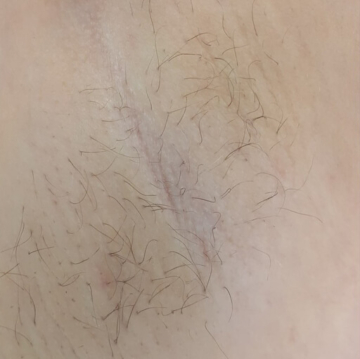 lazernaya-epilyacziya-svetlyh-volos-12-do