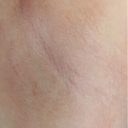 олександритовий лазер для світлого волосся