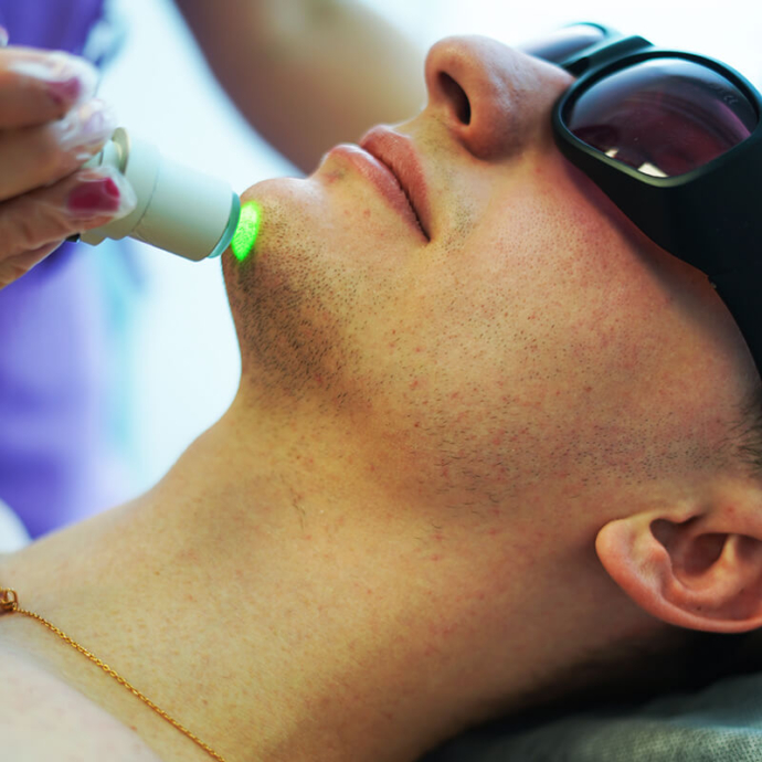 laserowe usuwanie brody