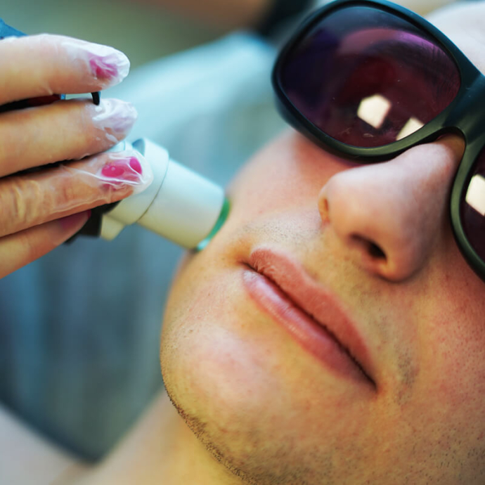 depilacja laserowa brody cena