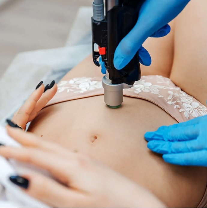 depilacja laserowa głębokiego bikini wstydzę się
