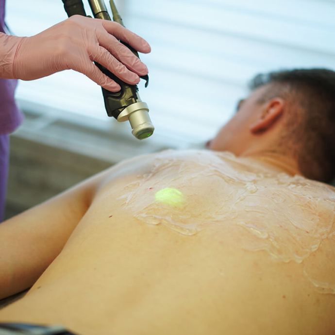 лазерна епіляція спини чоловіків ціна