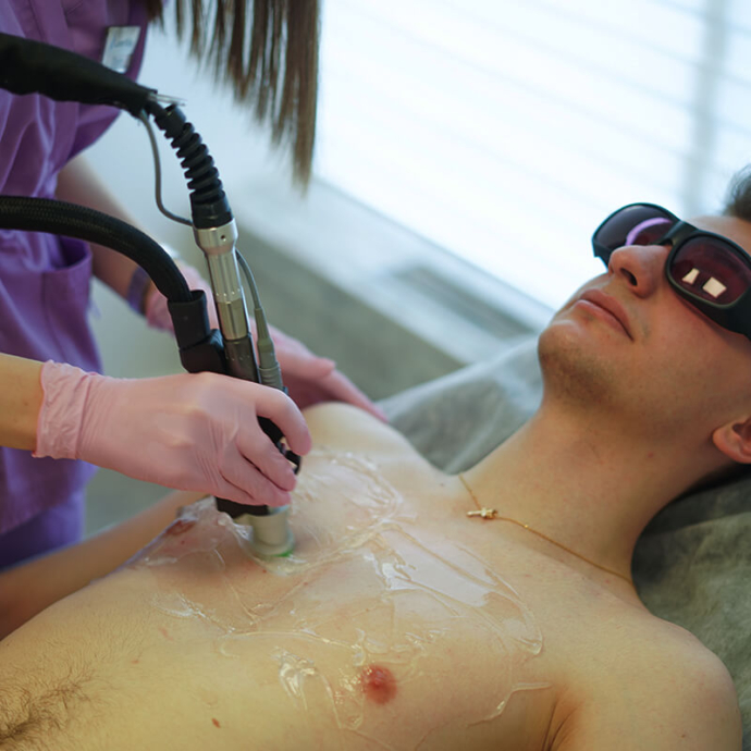 лазерна епіляція груди чоловіків відгуки