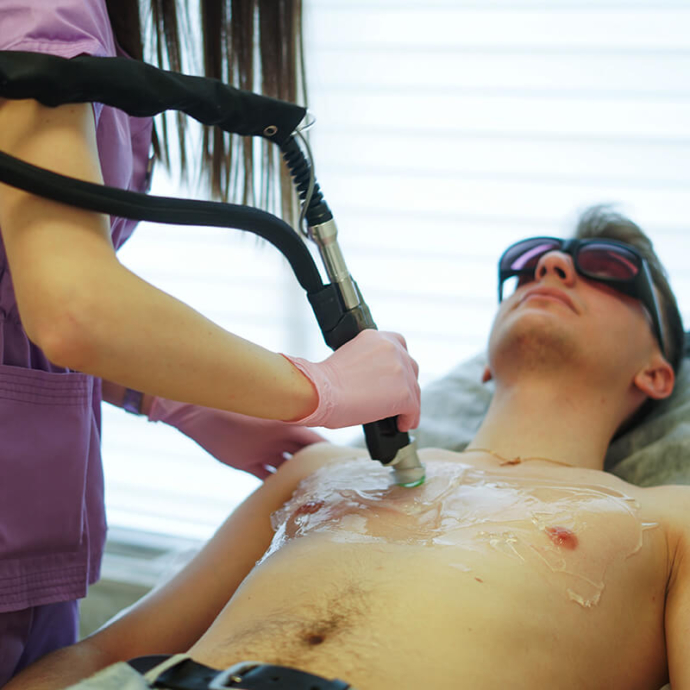 лазерна епіляція на грудях у чоловіків