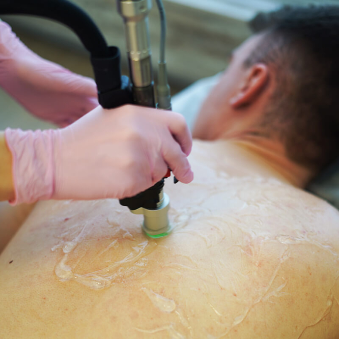 лазерна епіляція спини у чоловіків фото