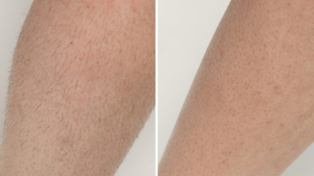 gallery-cholovicha-lazerna-epilyacziya-nig-01