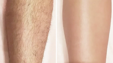 gallery-cholovicha-lazerna-epilyacziya-nig-02