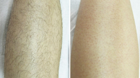 gallery-cholovicha-lazerna-epilyacziya-nig-03