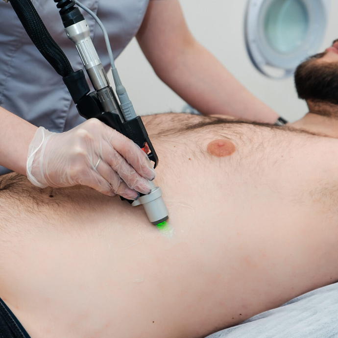 лазерна епіляція живота