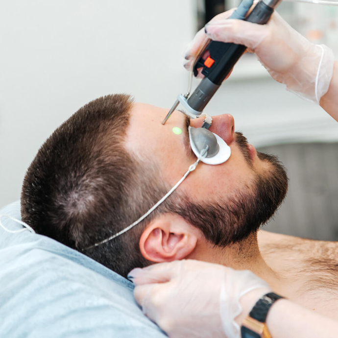 лазерна епіляція брів для чоловіків фото