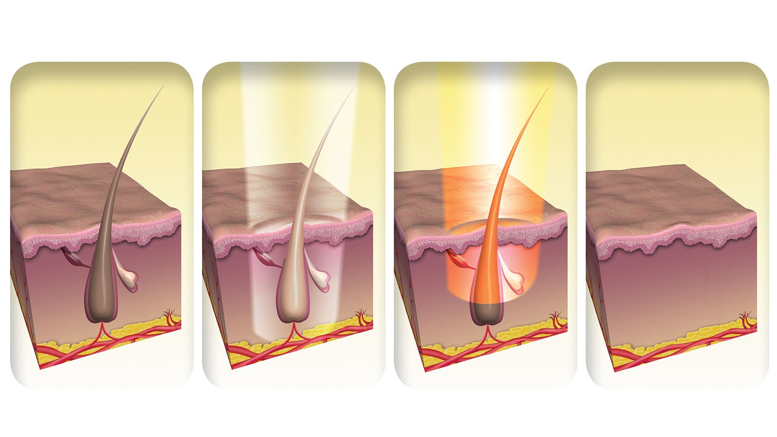 Why laser hair removal doesn't work