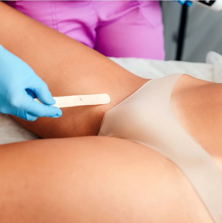 Preparation for laser hair removal