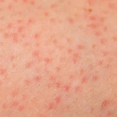 воспаление фолликул после лазерной эпиляции