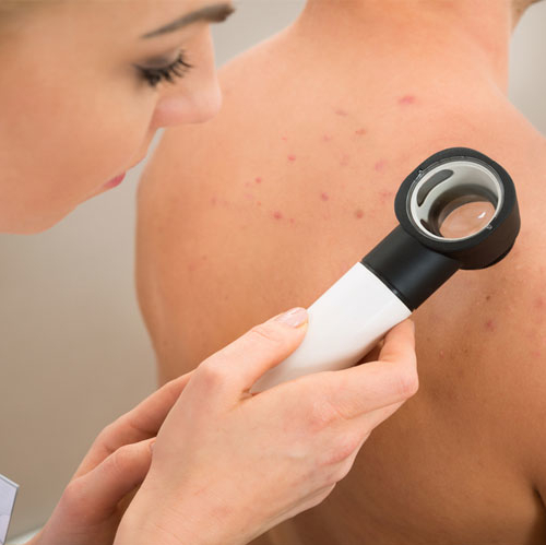 can you undergo laser hair removal with acne