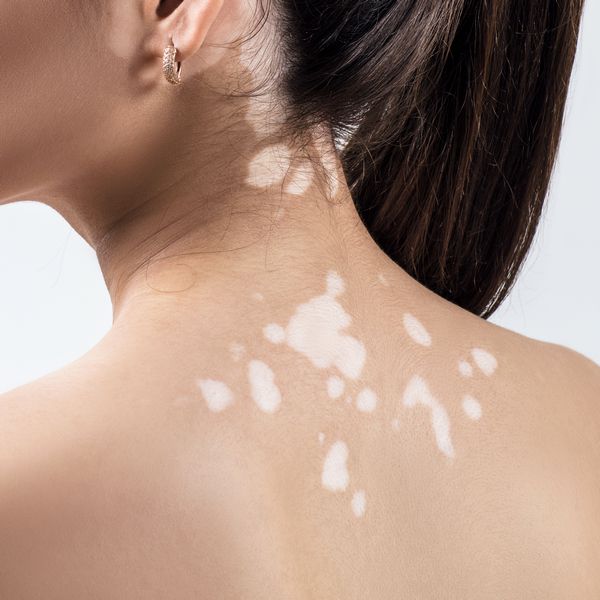 laser hair removal and vitiligo