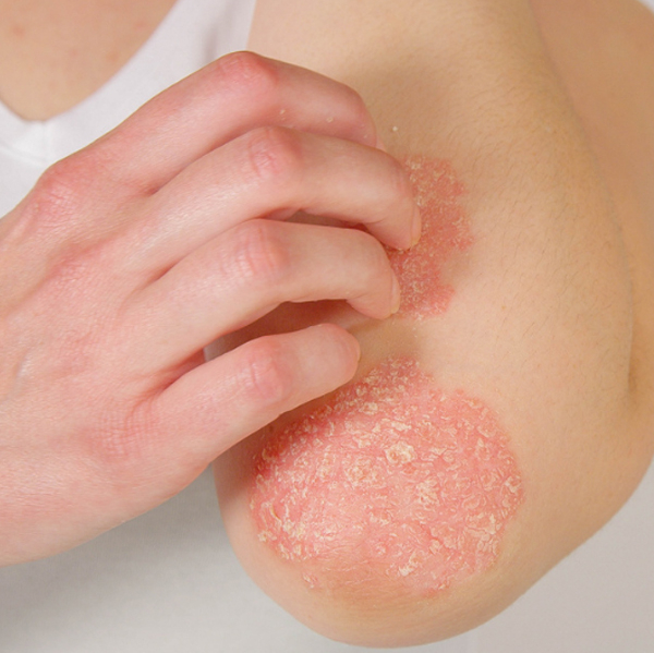 can psoriasis patients undergo laser hair removal