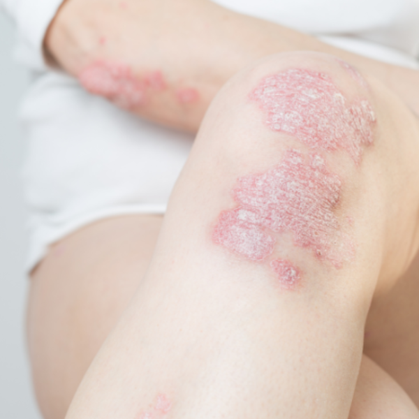 is laser hair removal possible for psoriasis patients