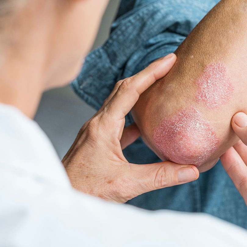 psoriasis and laser hair removal