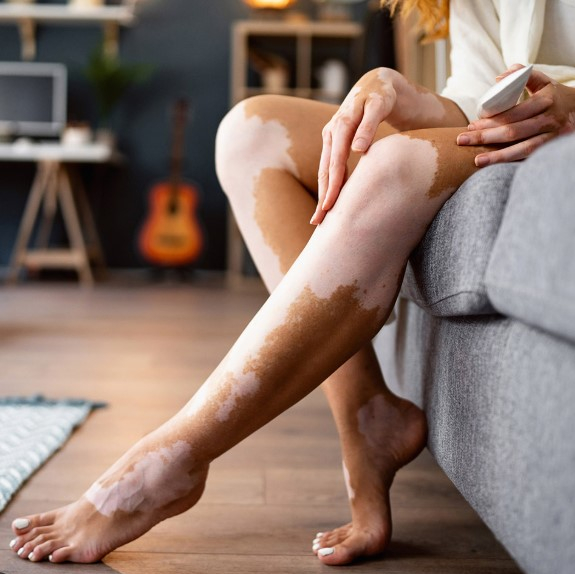 vitiligo laser hair removal