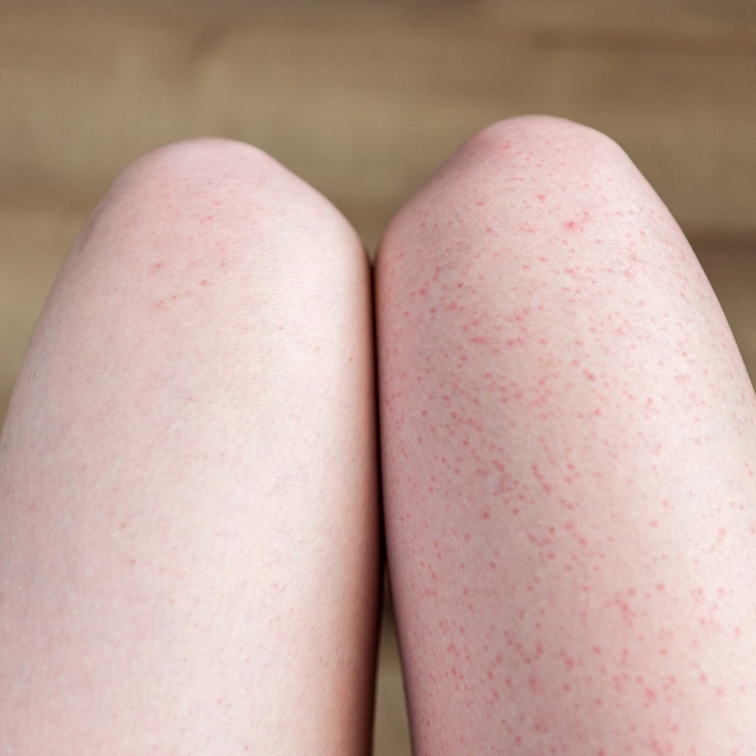 Complications after laser hair removal