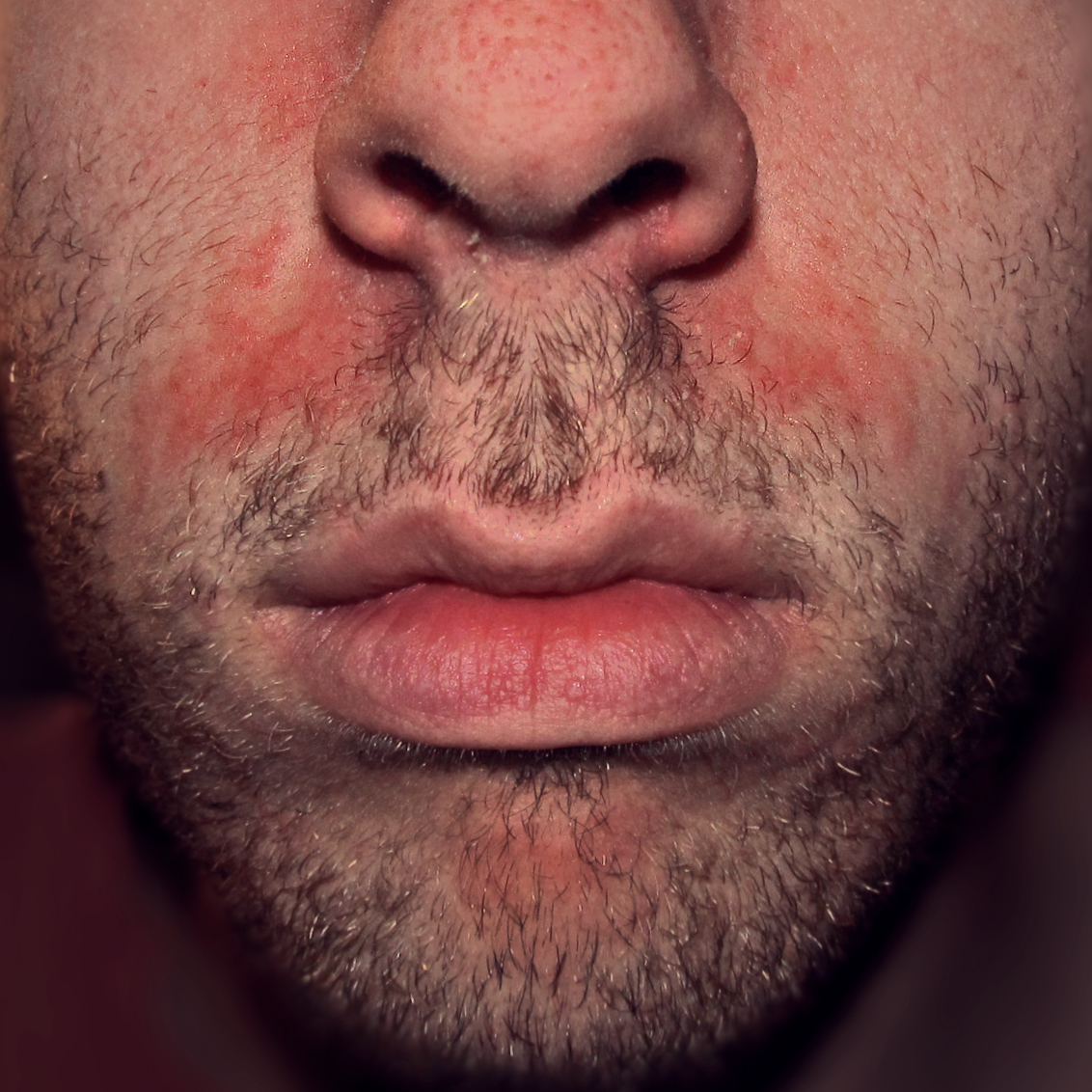 2 Seborrheic dermatitis