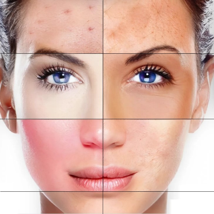 6 Seborrheic dermatitis