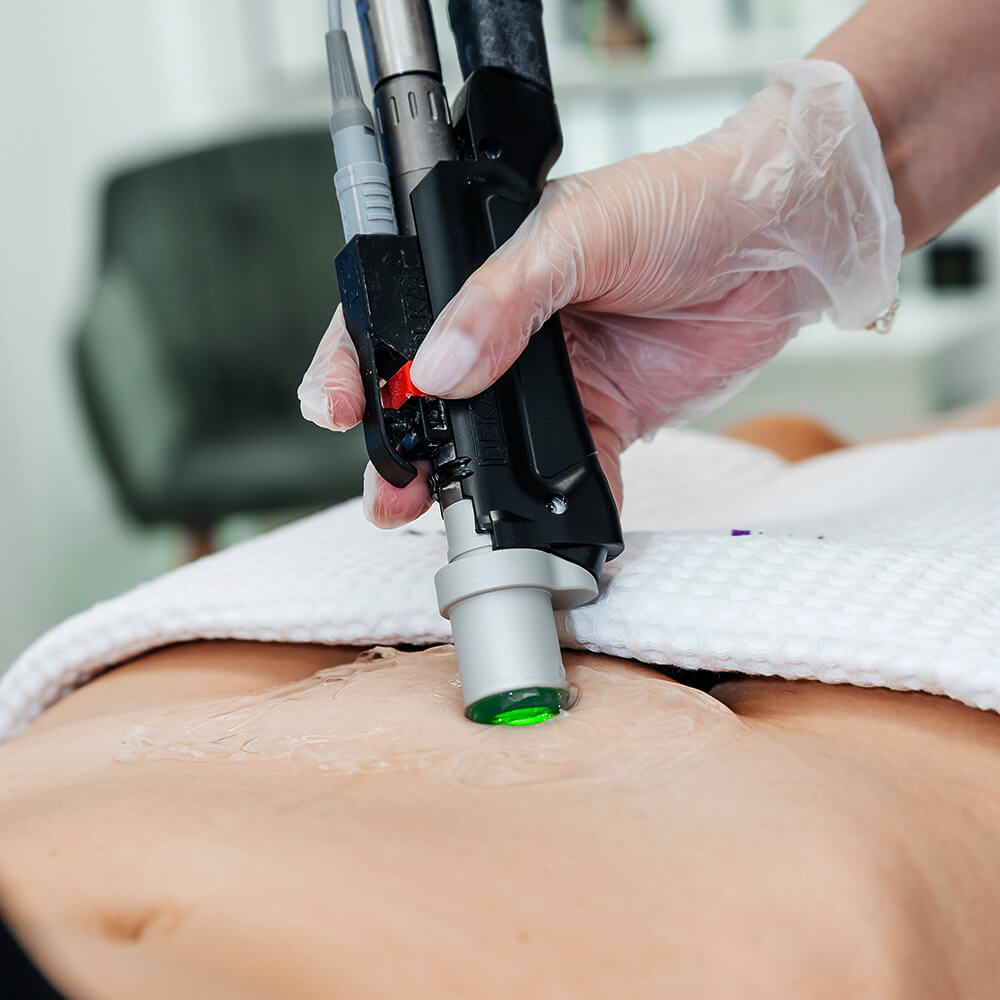 3 laser hair removal for women