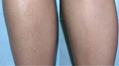 Фото до після: Ноги