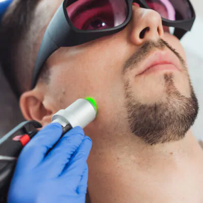 лазерна епіляція для чоловіків