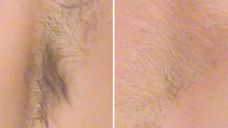 Фото до після: Під пахвами