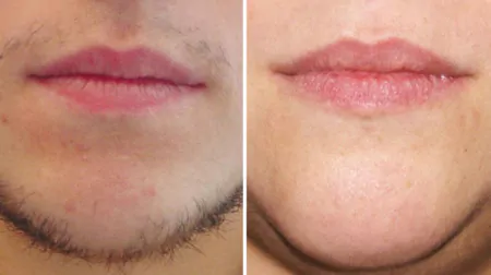 Фото до після: Обличчя повністю